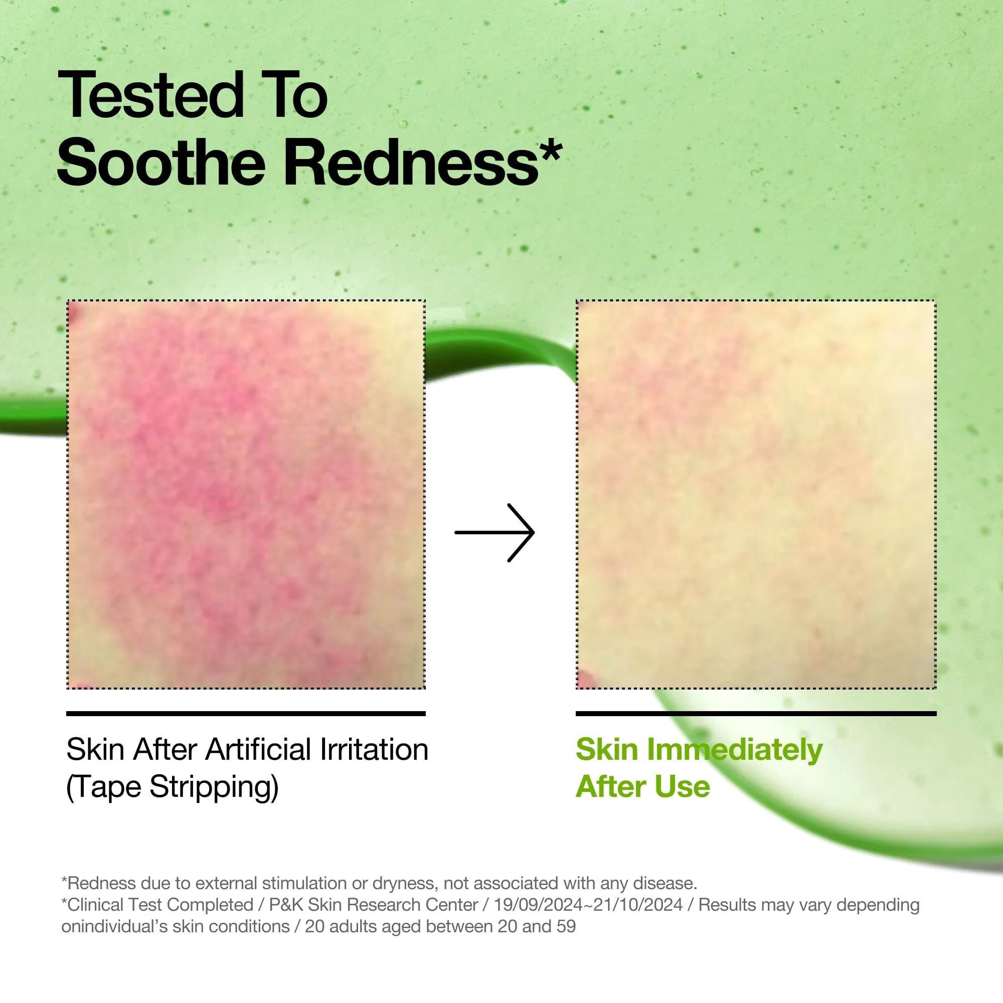 Before-and-after comparison of skin redness with a green background and text about soothing redness.