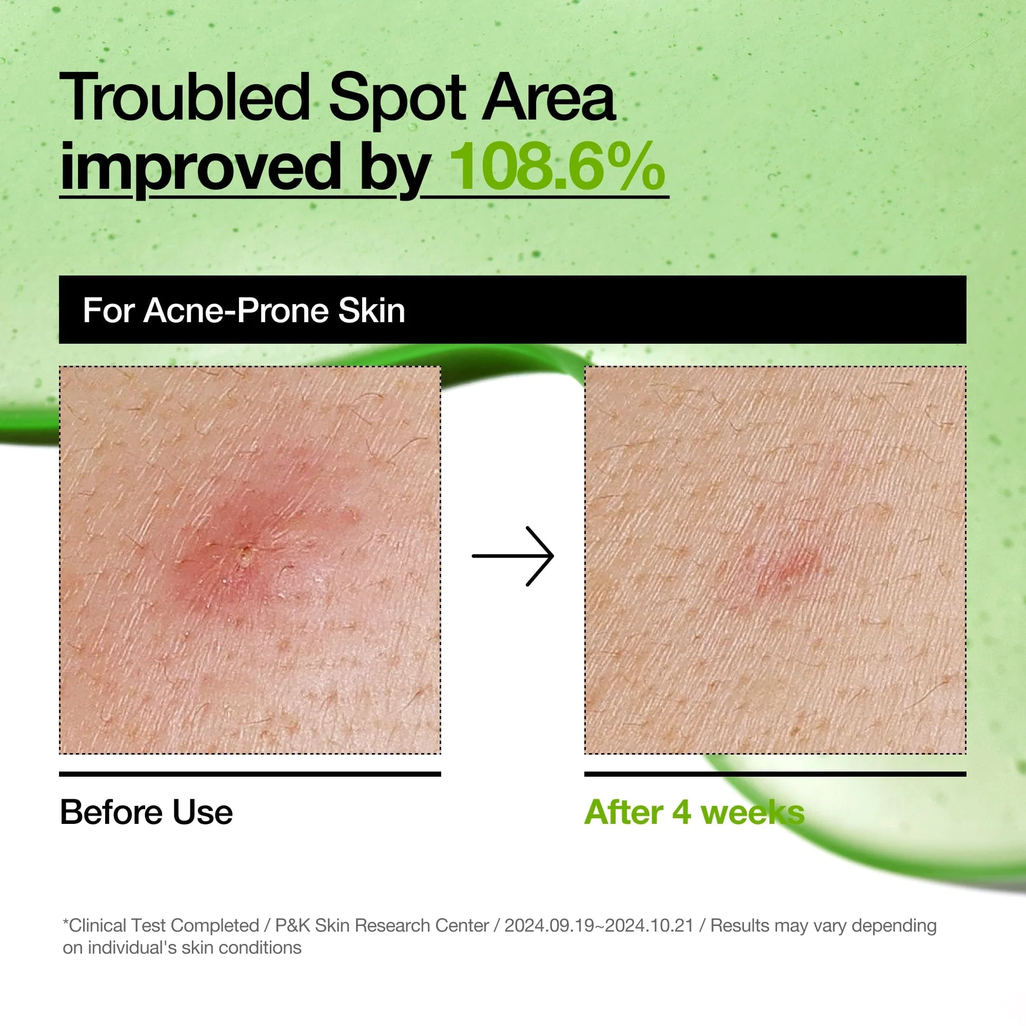 Before and after comparison of acne-prone skin treatment with text indicating improvement percentage.